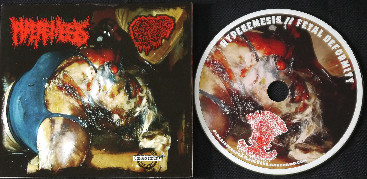 HYPEREMESIS / FETAL DEFORMITY - Split Digi ProCDr