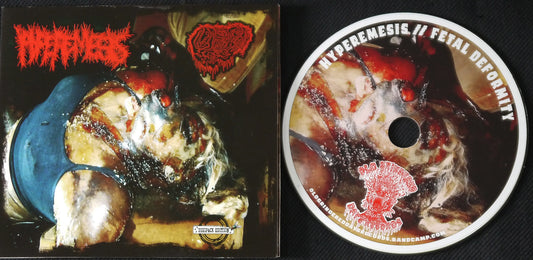 HYPEREMESIS / FETAL DEFORMITY - Split Digi ProCDr