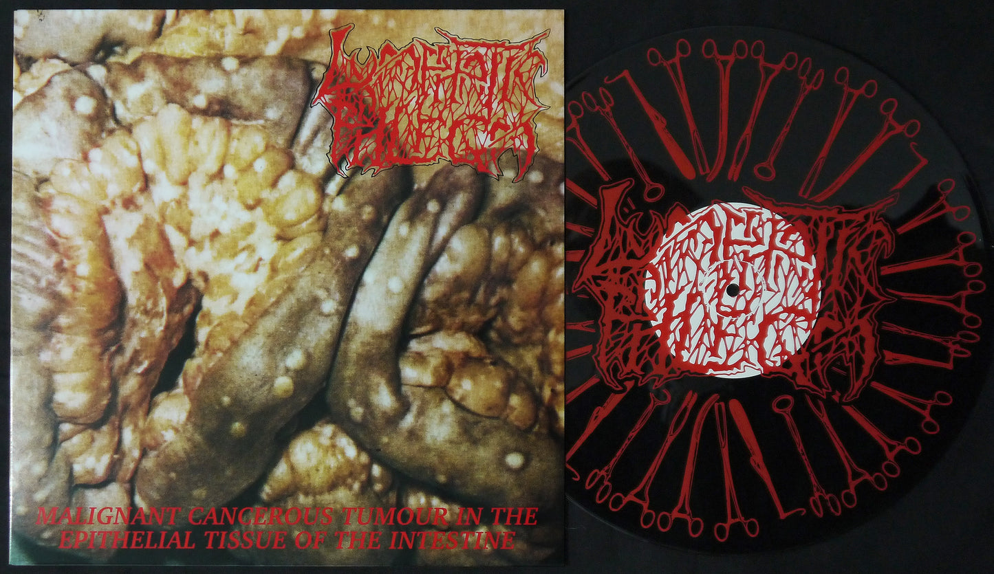 LYMPHATIC PHLEGM - Malignant Cancerous Tumor In The Epitelial Tissue Of The Intestine 12"S/Sided