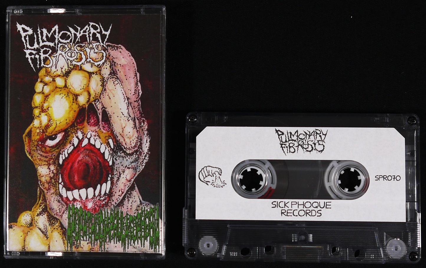 PULMONARY FIBROSIS / APOPATHODIAPHULATOPHOBIE - Split Tape