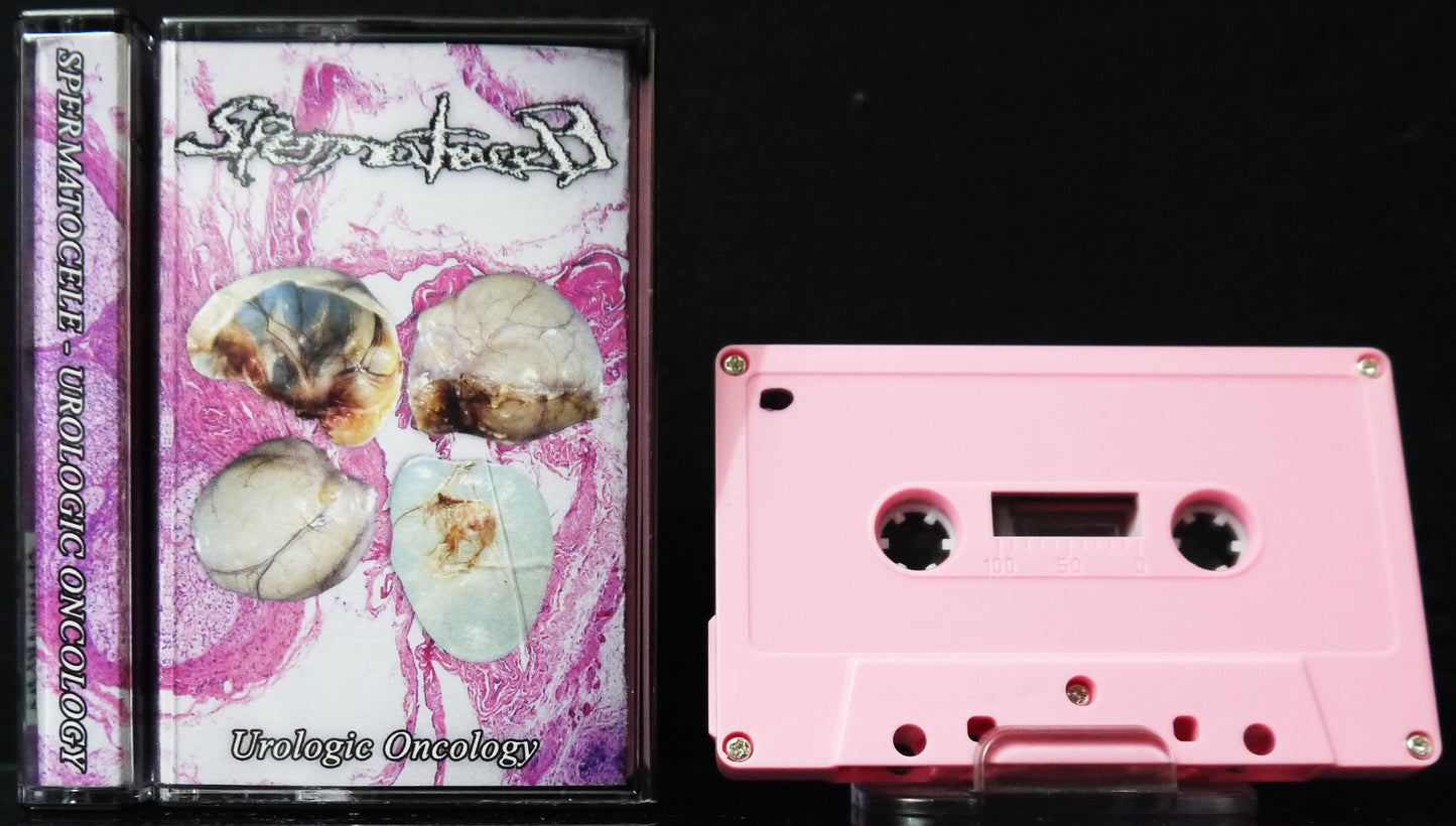 SPERMATOCELE - Urologic Oncology MC Tape