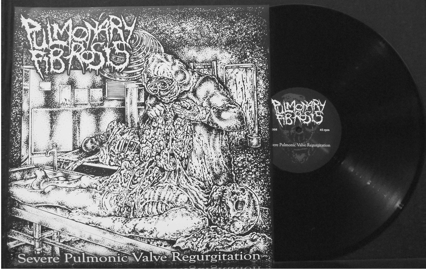 PULMONARY FIBROSIS - Severe Pulmonic Valve Regurgitation 12" S/Sided