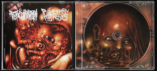 PULMONARY FIBROSIS / FETAL DOMINATION - Split CD