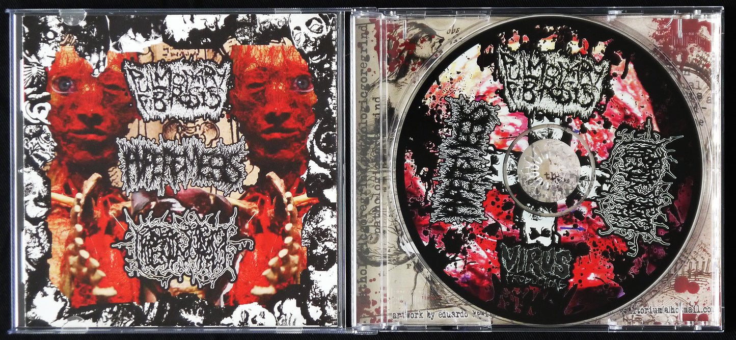 HYPEREMESIS / PULMONARY FIBROSIS / HIPERMENORREA - 3 Way Split CD