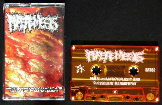 HYPEREMESIS - Failed Pharyngyoplasty And Subsequent Management MC Tape