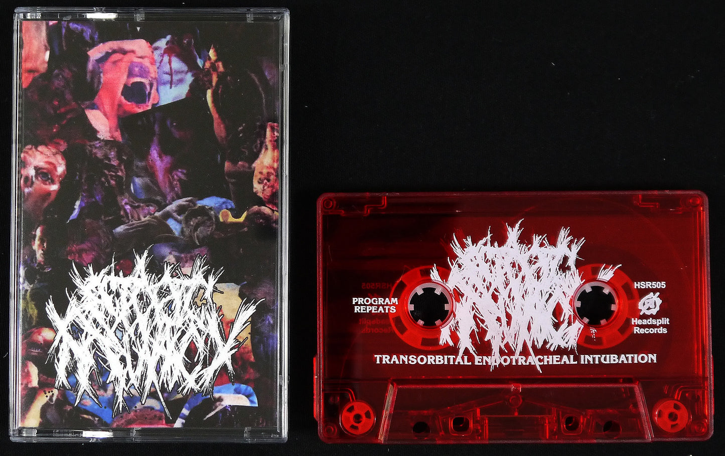 ECTOPIC  PREGNANCY - Transorbital Endotracheal Intubation MC Tape