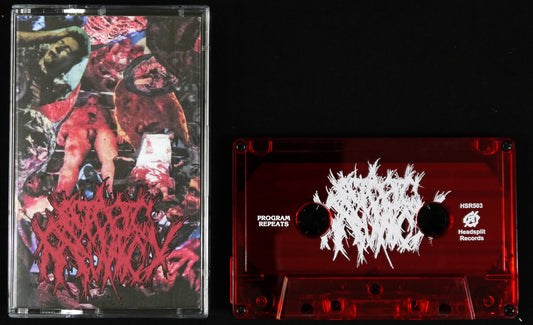 ECTOPIC  PREGNANCY - EP MC Tape