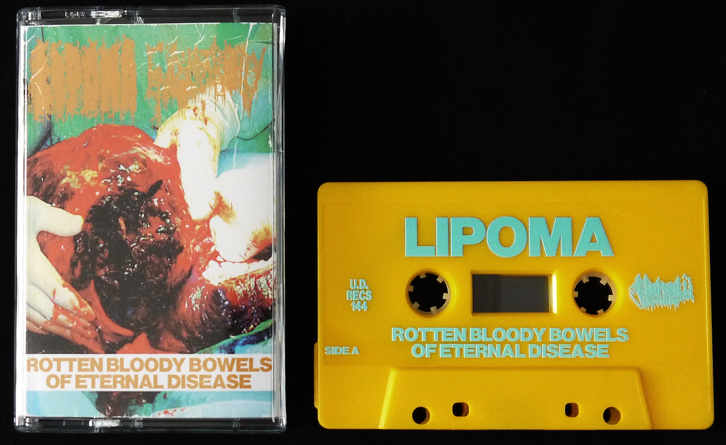 LIPOMA / ENDOMETROSITY - Split Tape