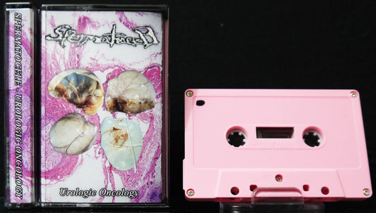 SPERMATOCELE - Urologic Oncology MC Tape