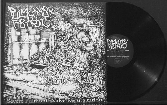 PULMONARY FIBROSIS - Severe Pulmonic Valve Regurgitation 12" S/Sided